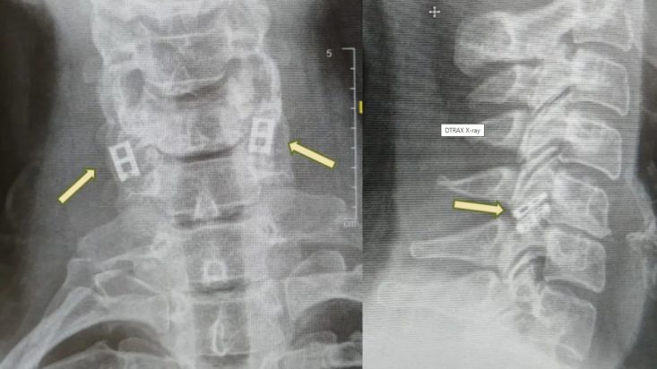 Ισραήλ: Πρώτη παγκόσμια μεταμόσχευση ανθρώπινου νωτιαίου μυελού με κύτταρα του ίδιου του ασθενούς – Επανάσταση στην αναγεννητική ιατρική
