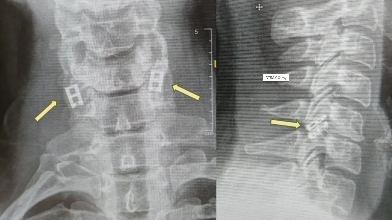 Ισραήλ: Πρώτη παγκόσμια μεταμόσχευση ανθρώπινου νωτιαίου μυελού με κύτταρα του ίδιου του ασθενούς – Επανάσταση στην αναγεννητική ιατρική