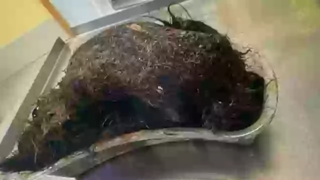 Μητέρα έμεινε άφωνη με την ανακάλυψη των γιατρών - Η «δυσανεξία» της κόρης της στη γλουτένη ήταν στην πραγματικότητα μια τριχόμπαλα στο στομάχι της - Ήταν σε μέγεθος πεπονιού.