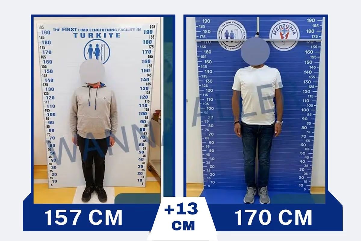 Επιμήκυνση άκρων στην Τουρκία με… 23.000 ευρώ: Τους «σπάνε» τα πόδια με σκοπό να γίνουν ψηλότεροι