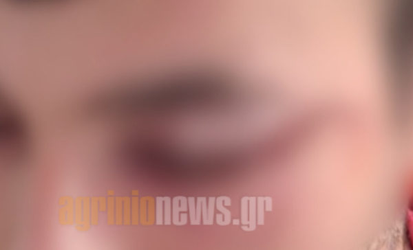Ο 22χρονος θύμα της οπαδικής επίθεσης στο Αγρίνιο