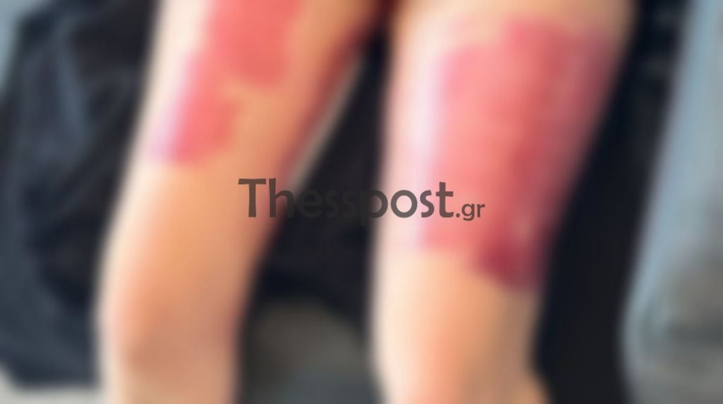 Εφιάλτης για 20χρονη στη Θεσσαλονίκη: Μπήκε στο νοσοκομείο για επέμβαση ρουτίνας και κατέληξε με εγκαύματα τρίτου βαθμού