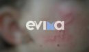 Εύβοια: Σχεδόν αόρατες μέδουσες τσίμπησαν παιδί στο πρόσωπο